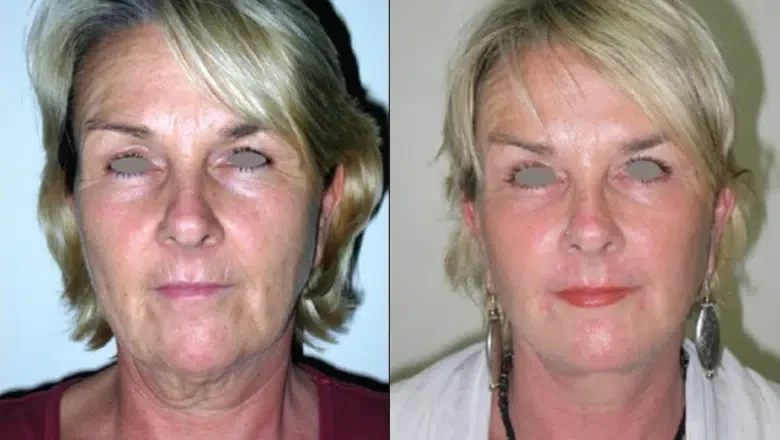 facelift-before-after-3.png-2.webp