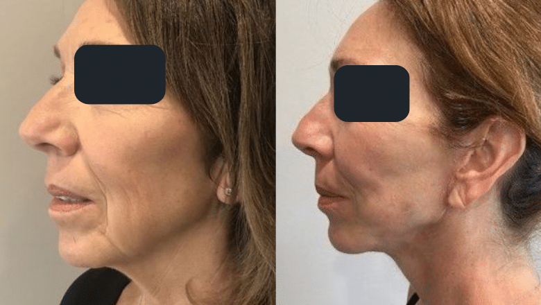 mini-facelift-surgery-before-and-after-3-1.png