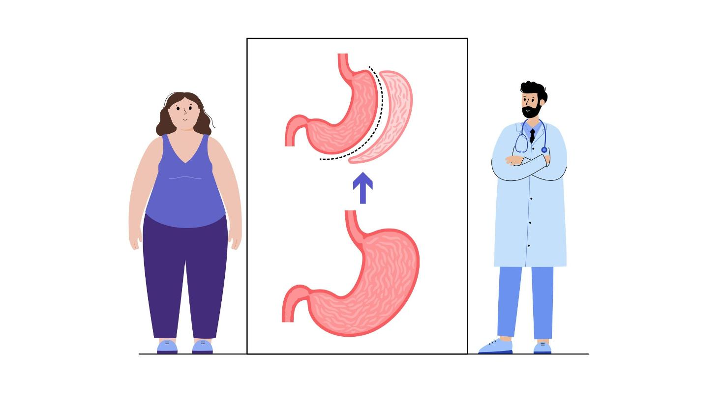 A Comprehensive Guide to Gastric Sleeve Surgery Abroad