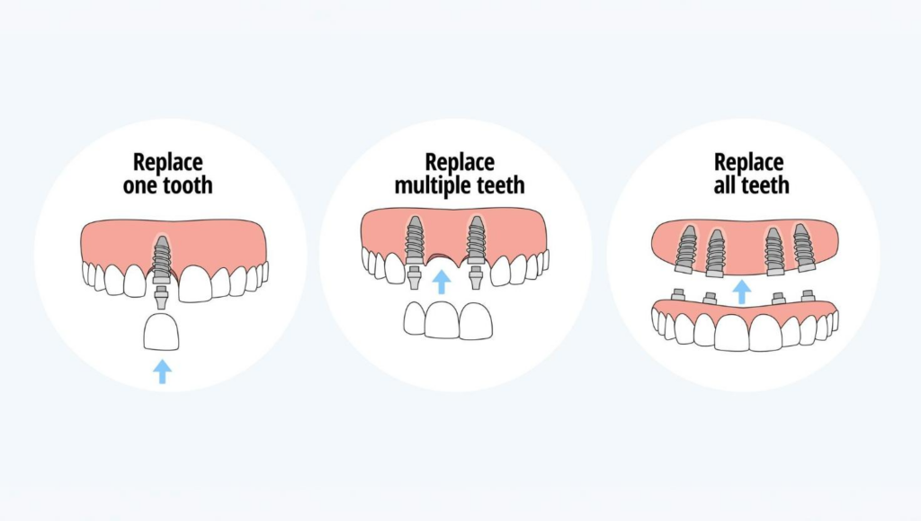 All-on-4 Dental Implants Abroad: What You Need to Know