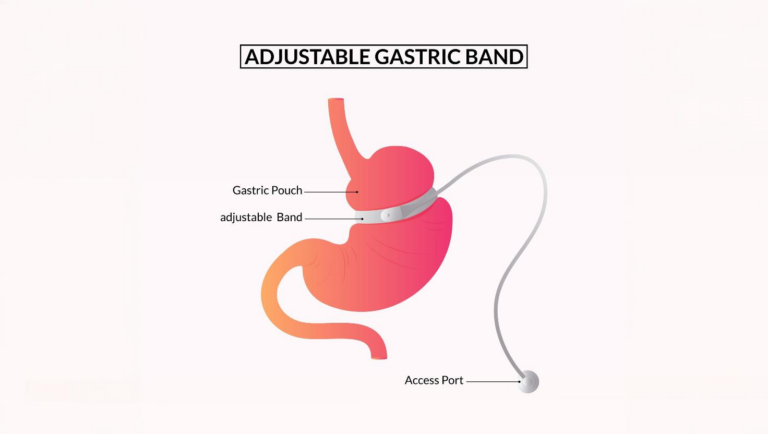Gastric Band Surgery: A Comprehensive Guide for Weight Loss Seekers