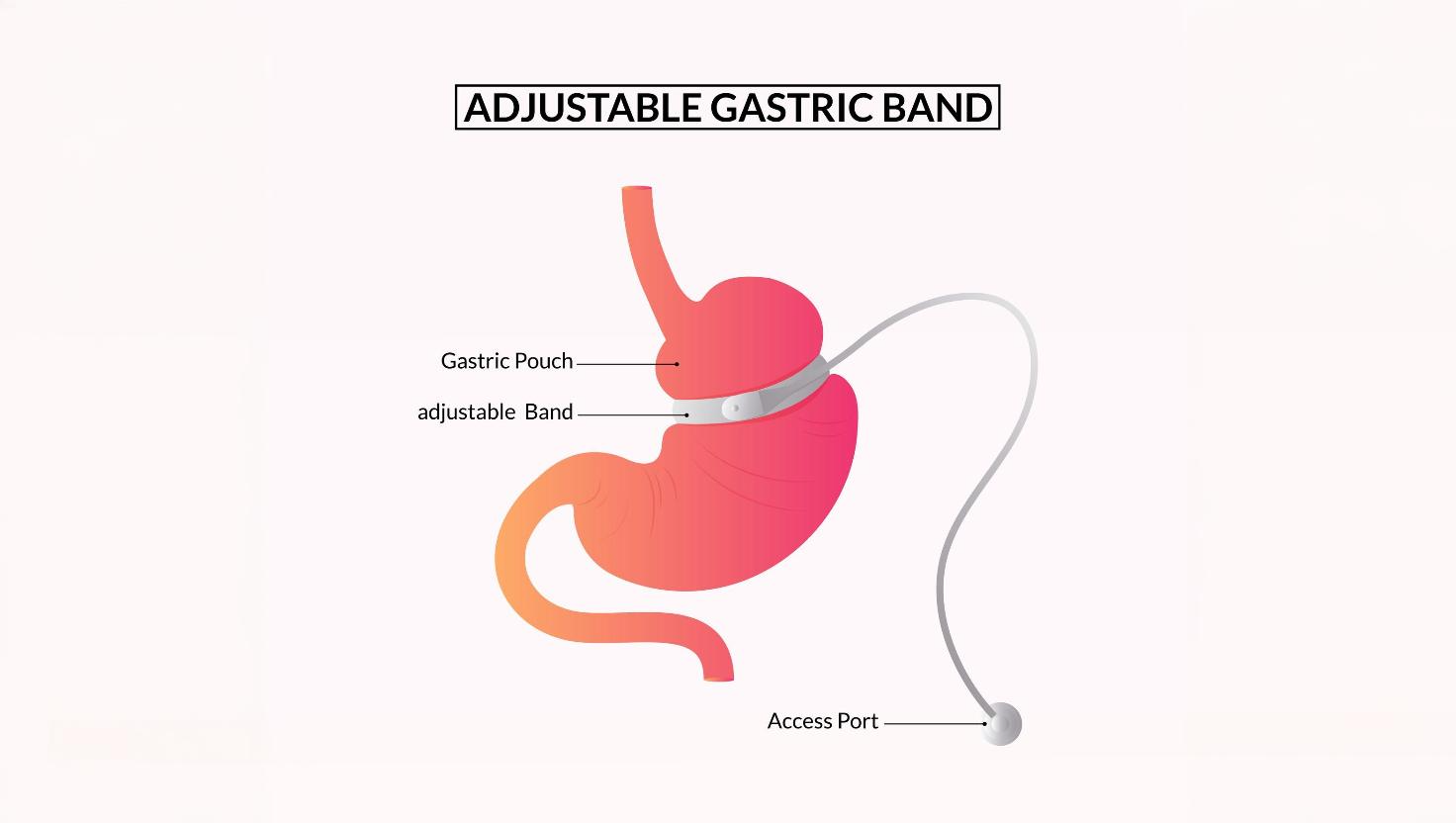 Gastric Band Surgery: A Comprehensive Guide for Weight Loss Seekers